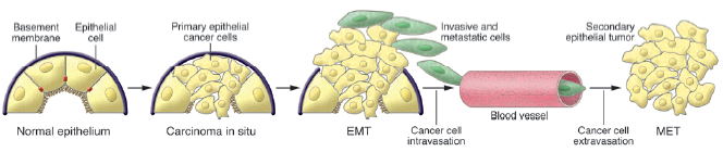 EMT与癌症侵袭