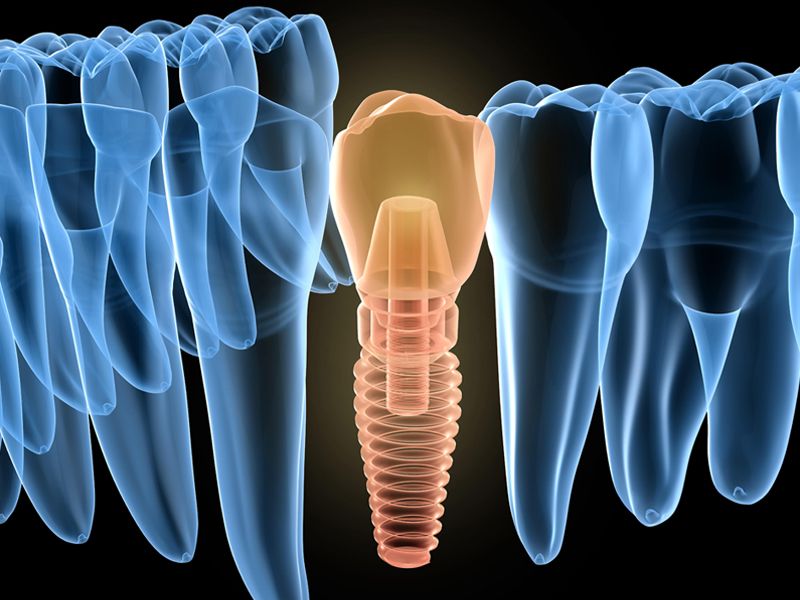 Read more about the article 美味的贻贝与合金种植体碰撞出了火花？